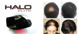 Laser Therapy for Hair Growth Southampton