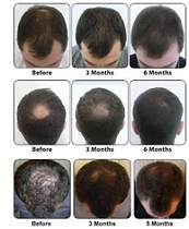 Hair Restoration Laser Treatment Southampton